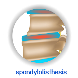 image of Tonawanda spondylolisthesis